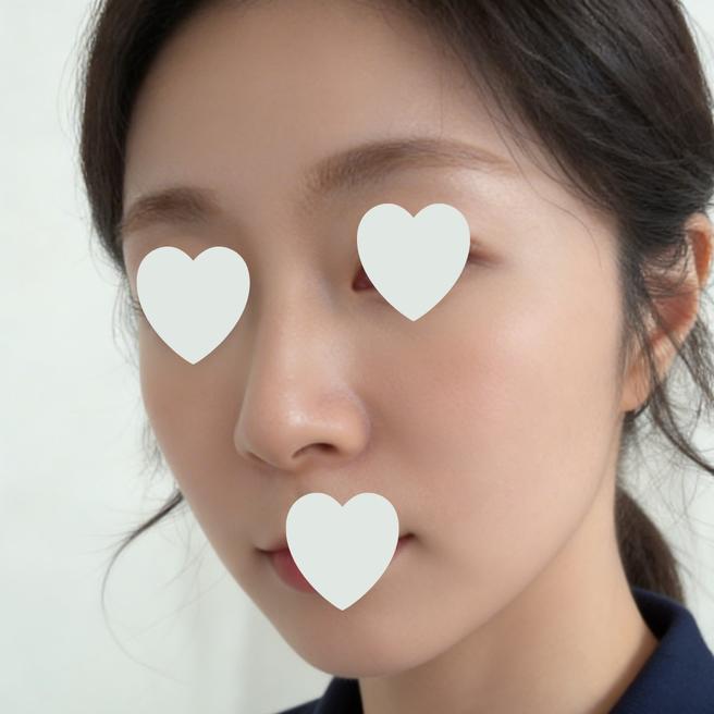 리즈네 맞은 지 4주 됐는데 요즘 피부가 달라진 것 같아요 