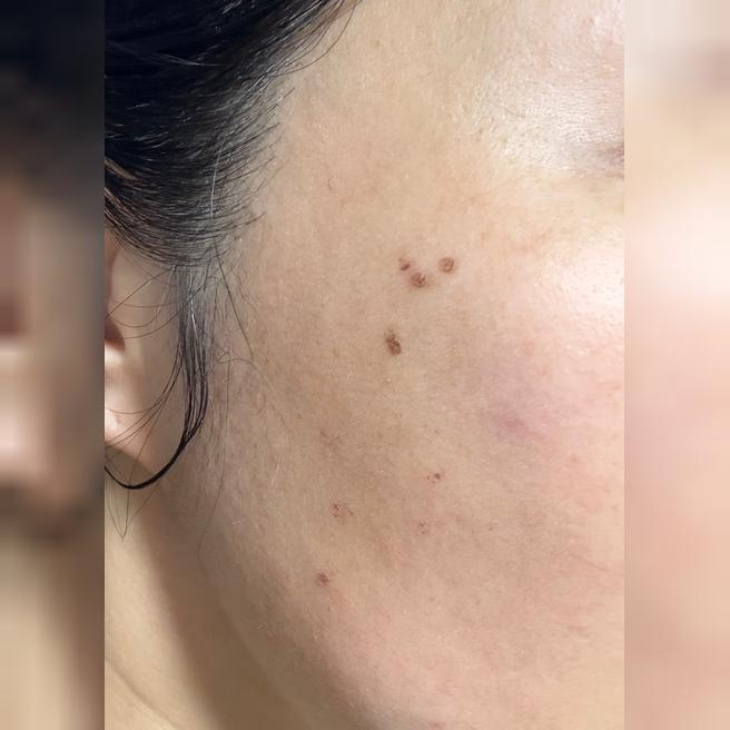 간호사분들 친절하고 속 건조도 잘 잡아줘서 시술도 마음에 들어서 또 왔어요~