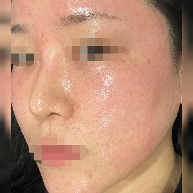 당김 심했는데 리쥬란 받고 촉촉해진 느낌이에요 ㅎㅎ