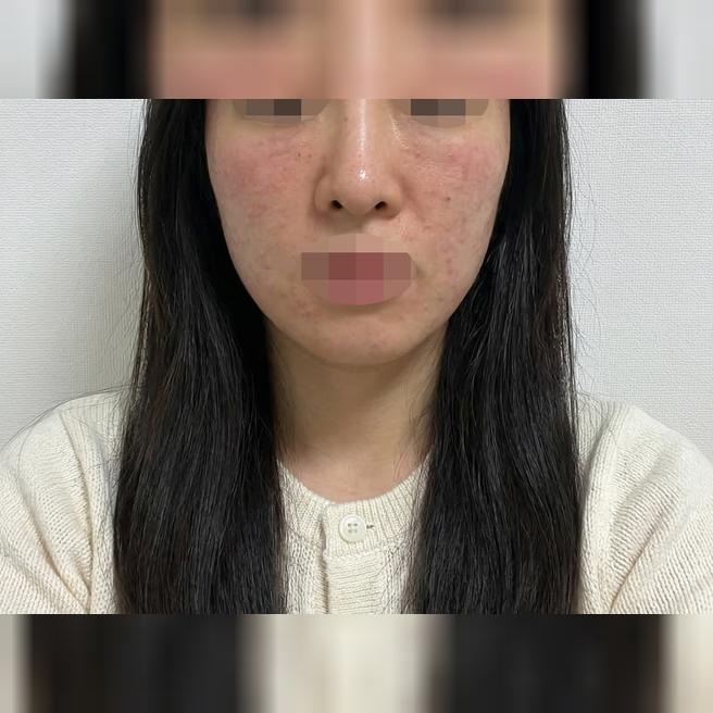 건성이라 리쥬란 꾸준히 받는데 가격도 좋고 케어도 확실해서 만족해요 ㅎㅎ