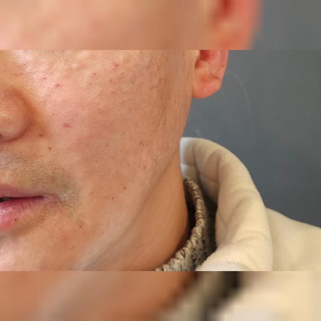 수면으로 통증 없이 리쥬란 주기적으로 받고 있어요!