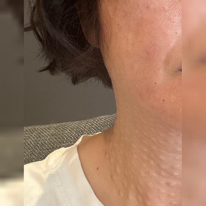 눈가 잔주름이랑 속건조 고민으로 리쥬란 꾸준히 재방문하고 있어요