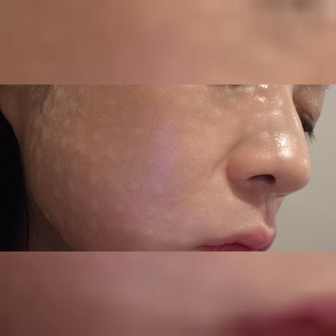 한국 방문 김에 리쥬네+보톡스 받았는데 다음날부터 탄력이 느껴졌어요~!