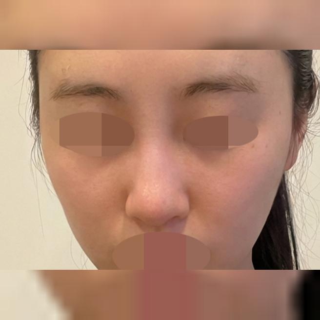 이마라인이랑 주름 고민으로 필러 받았는데 만족이에요 ㅎㅎ
