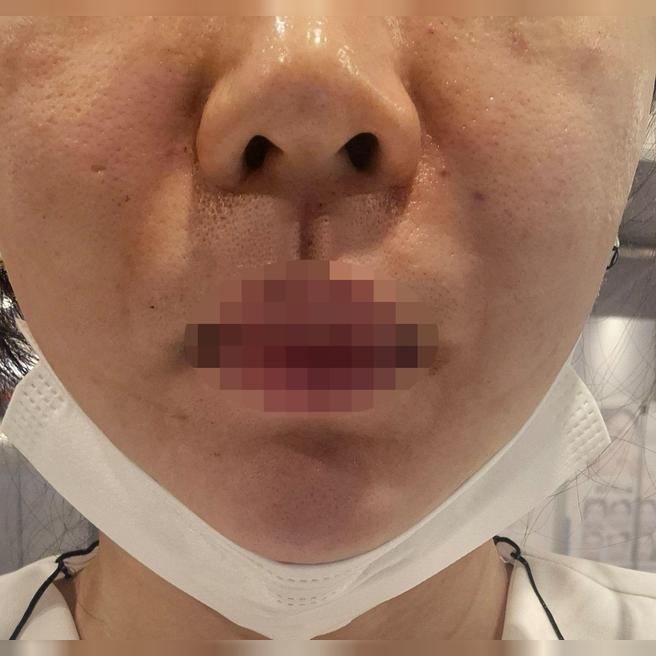 모공 관리 시작하려고 방문했는데 꼼꼼한 시술에 결과까지 기대돼요~