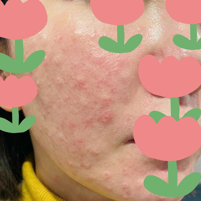 리즈네 맞고 왔어요!  1일차 경과 올려봅니다