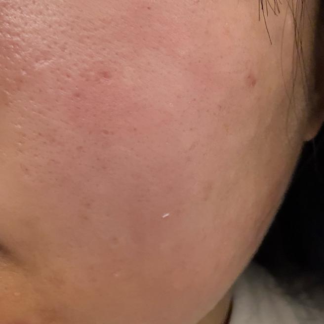 수면으로 여러 시술 한번에 받았는데 대기도 없이 친절해서 좋았어요!