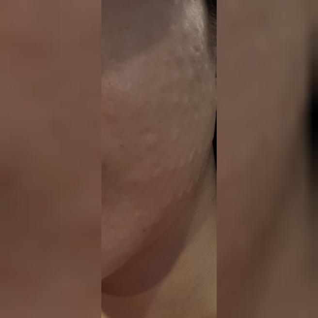 예전에 받아봐서 이번엔 수면으로 편하게 진행했어요~