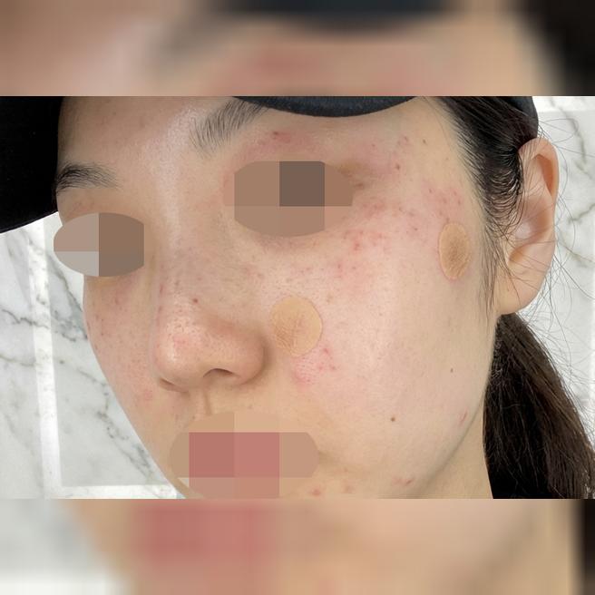 리팟레이저 수면으로 받았습니다~ 아프지 않아서 너무 좋았어요! 그리고 일본어 응대돼서 편했어요 ㅎㅎ