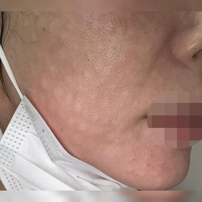 개인 맞춤으로 꼼꼼하게 해주는 리쥬란, 계속 다닐 것 같아요~