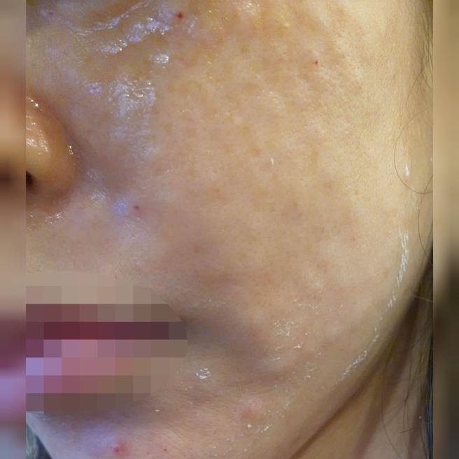 수면마취로 받으니 아픈지도 모르고 끝나서 너무 편했어요!!