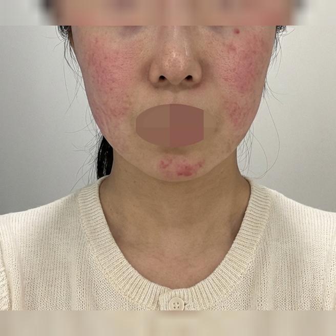 재방문입니다~ 수면으로 동시에 시술들 가능해서 너무 좋아요 ㅎㅎ