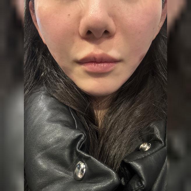 온다리프팅 1주 후기? 단골이니까 믿고 또 왔어요