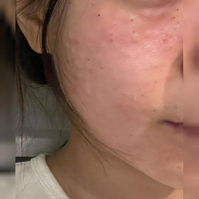 타 병원에서 효과 좋았던 리쥬란, 더 합리적인 곳 찾아서 방문했어요~