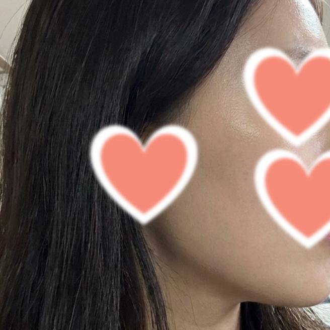 스킨보톡스 맞은 지 4일 됐는데 모공이 달라 보여요