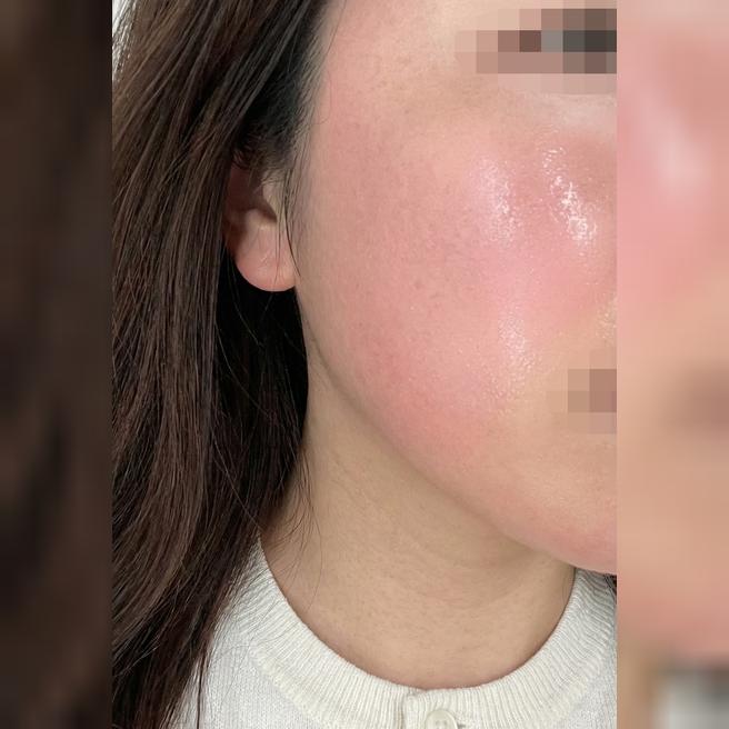 심부볼 고민으로 온다리프팅 받았는데 빠르고 좋은 것 같아요 ㅎㅎ