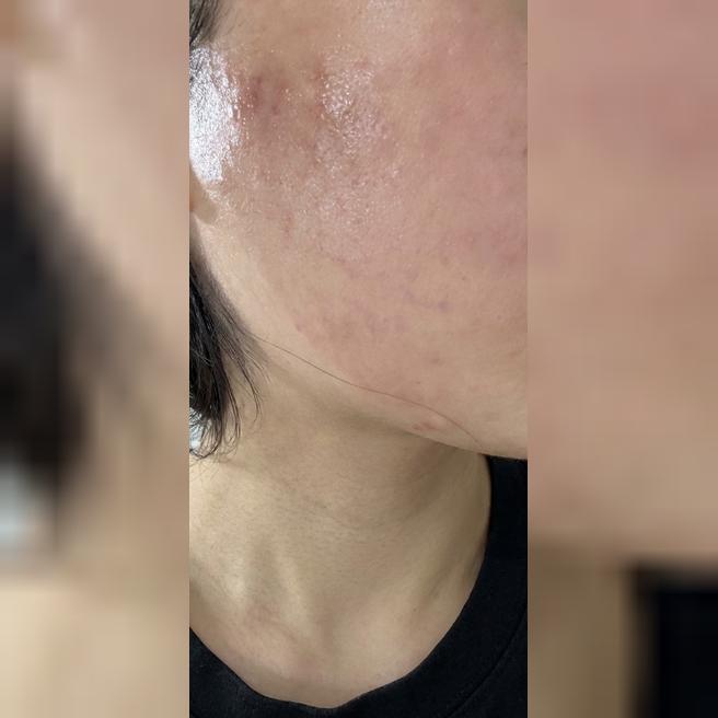 피부 뒤집힘 + 지인 추천으로 받은 첫 리쥬란 받아봤어요!!