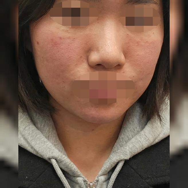 리쥬란이랑 써마지 같이 받았는데 수면이라 편한 것 같아요 ㅎㅎ