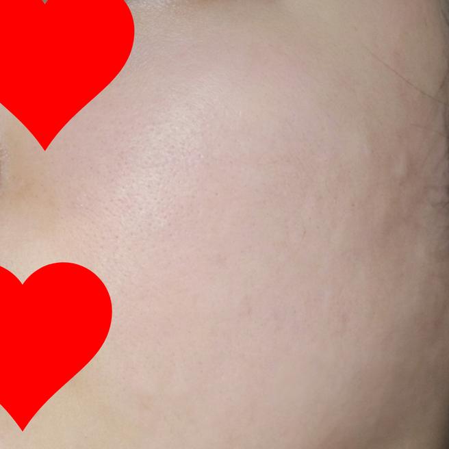 리쥬란 효과는 2주차부터! 매끈해진 경과 후기 