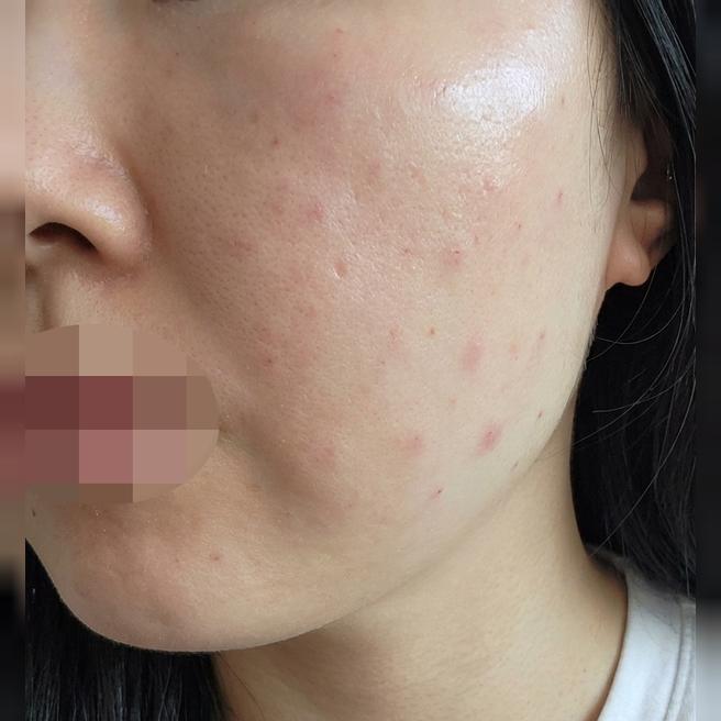 아무리 발라도 흡수 안 되는 피부, PRP로 속부터 채워봤어요~