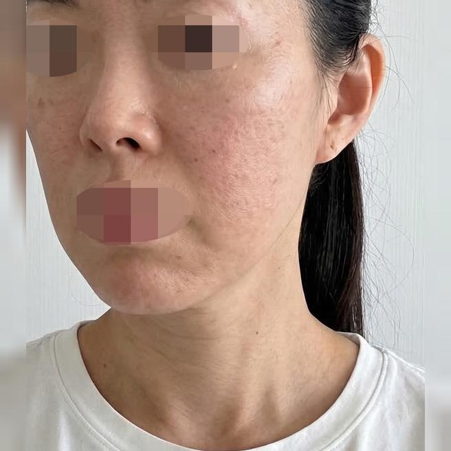 리쥬란이랑 스킨보톡스 같이 받았는데 효과 기대돼요~