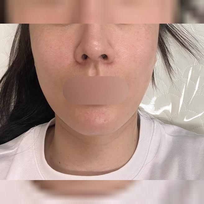 리쥬란 한 달차, 피부 개선이 확실히 보여서 만족이에요~
