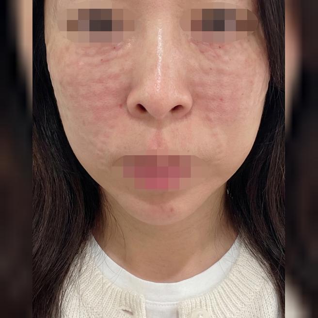 리쥬란 받았는데 친절하고 전문적이라 믿음이 가는 것 같아요~!