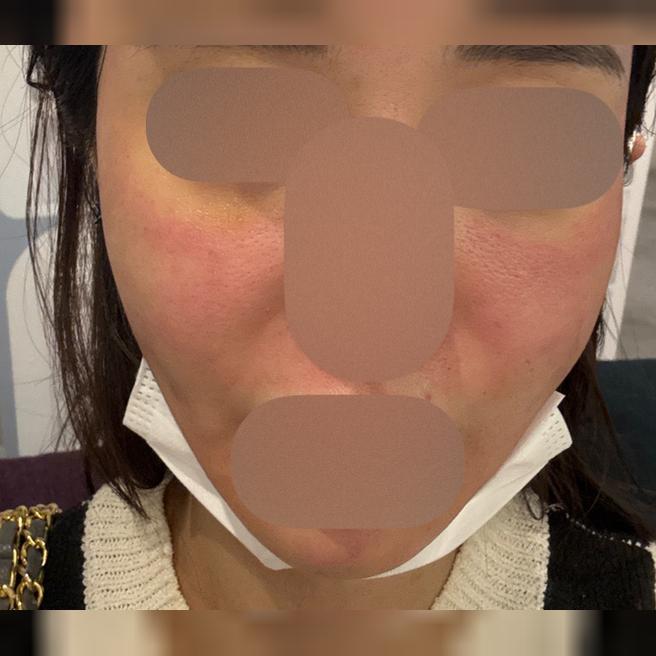 나이 들수록 필요한 리쥬란, 주기적으로 받으니 더 좋아요ㅎㅎ