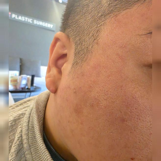 친절한 응대에 시술까지 만족, 남자도 부담 없이 받고 왔어요.
