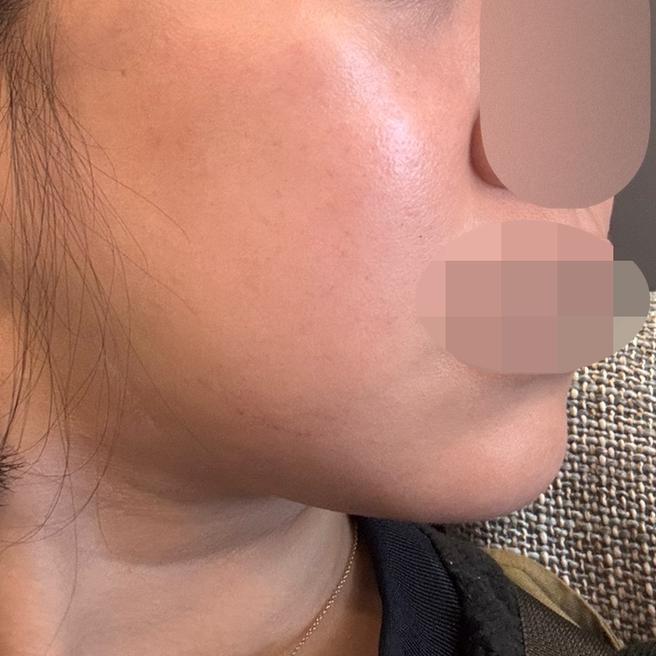 수면이라 편하게 받았고 마스크까지 챙겨줘서 좋았어요!