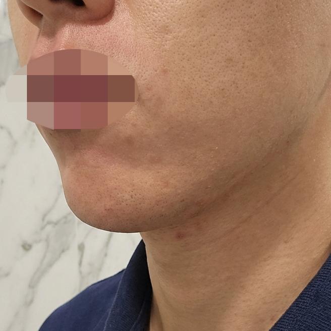 매일 아침 수염 관리가 번거로워서 레이저 제모 받아봤습니다.