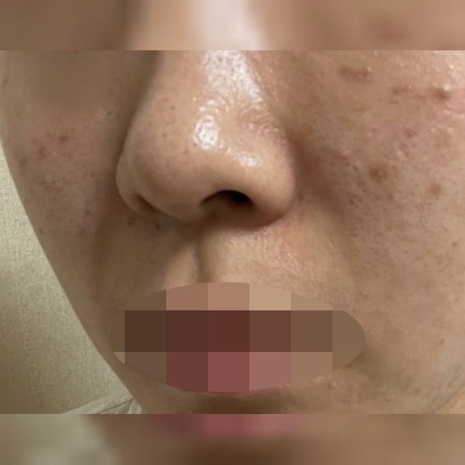 리쥬란 4cc 수면마취로 편하게 받았는데 결과까지 만족스러워요~