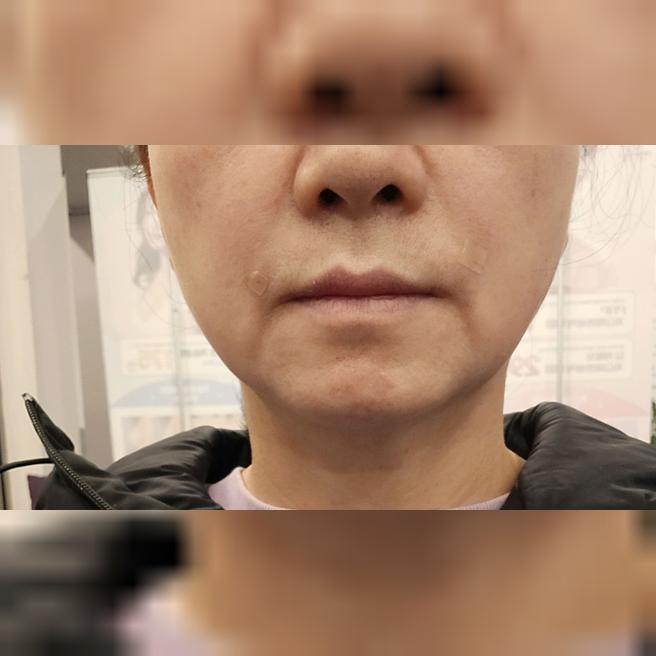 쥬베룩볼륨 2회차, 마취도 빨리 되고 효과도 슬슬 보여요~