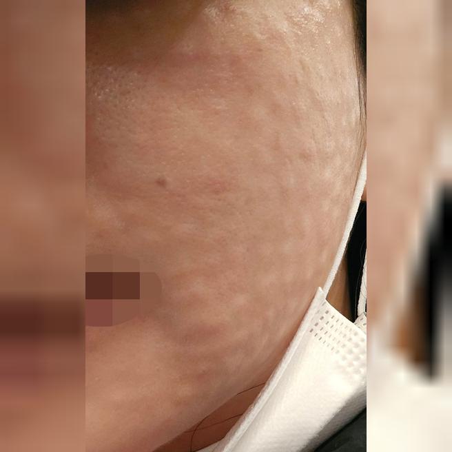 주기적으로 오는데 촘촘하게 해주셔서 엠보도 금방 사라져요 ㅎㅎ