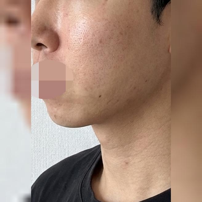 피부 푸석함이 신경 쓰여 리쥬란을 받았습니다~ 수면으로 진행해 아픔없이 진행해서 좋아요!
