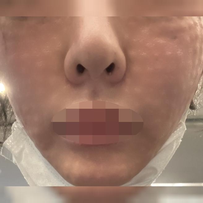리쥬란 한 번 받고 만족해서 3회 결제하고 지인한테도 소개했어요 ㅎㅎ