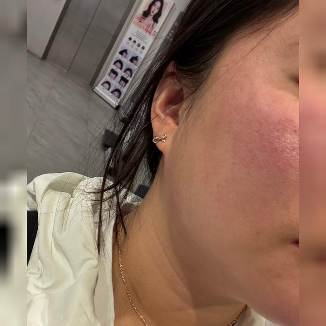 모공 스트레스였는데 스킨보톡스랑 슈링크 수면으로 받아서 통증 없이 좋았어요 ㅎㅎ