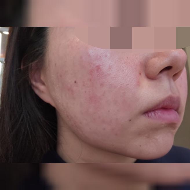 상담부터 체계적! 리쥬란 편하게 잘 받았어요ㅎㅎ
