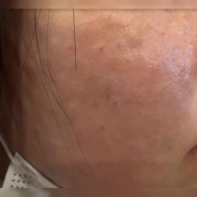 마취 덕분에 통증 없이 받았는데 엠보까지 꼼꼼하게 잘 나왔어요ㅎㅎ