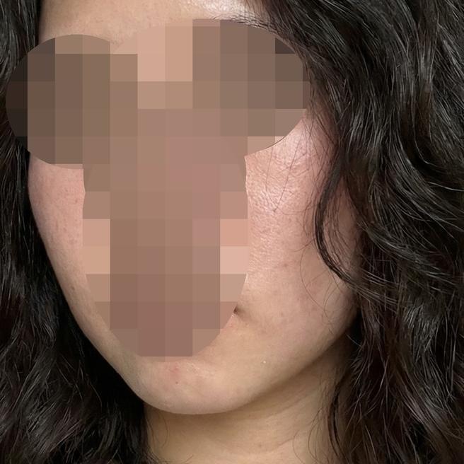 수면 리쥬란 받았는데 케어까지 해줘서 좋았습니다~