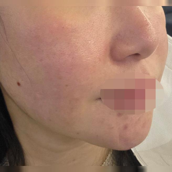 속건조 예방 차원으로 리쥬란 수면으로 편하게 받아봤어요