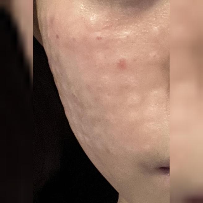 리쥬란 정품 인증 라벨까지 챙겨주시고 수면으로 받아서 아프지않게 믿고 받았어요ㅎㅎ