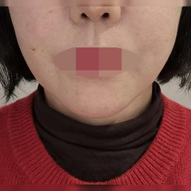 팔자주름 때문에 쥬베룩 볼륨 받았는데 자연스럽게 채워져서 만족이에요 ㅎㅎ