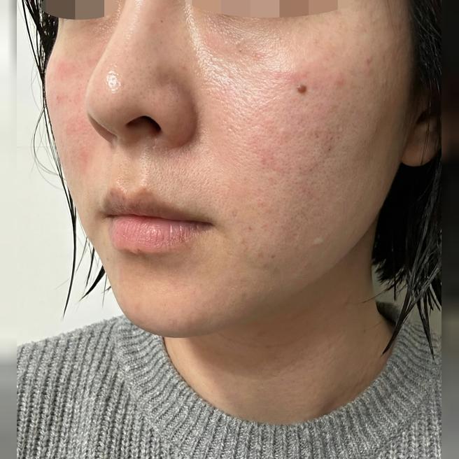 피부장벽 무너졌을 때 엑소좀! 트러블 완화에 딱이에요!