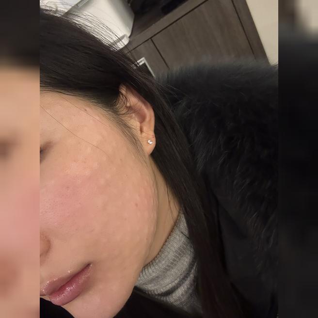 수면마취 걱정했는데 꿀잠 자고 왔어요 (엠보싱 대박)