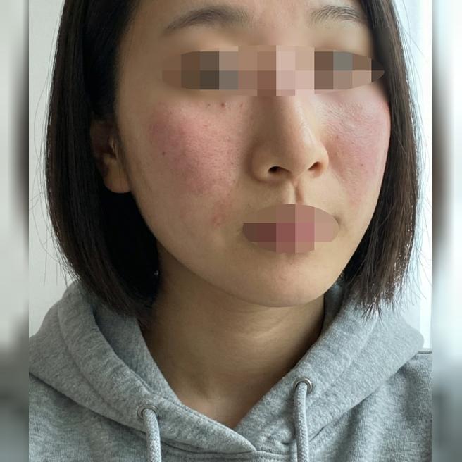 리쥬란 받았는데 꼼꼼하게 해주시고 피부 촉촉해진 것 같아요~다들 친절해서 또 오려고요!