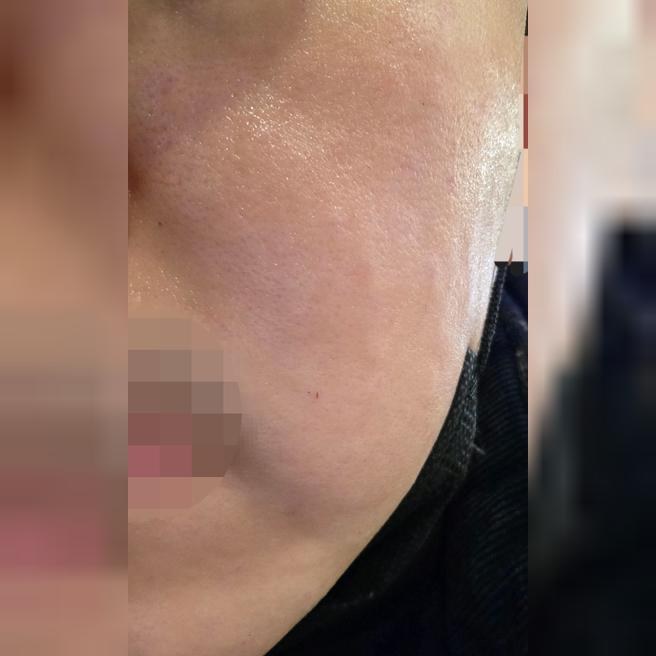 리쥬란 받았는데 수면으로 진행해서 통증도 없고 케어까지 해줘서 좋네요~