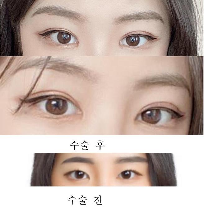 매몰 앞뒤트 후기!!