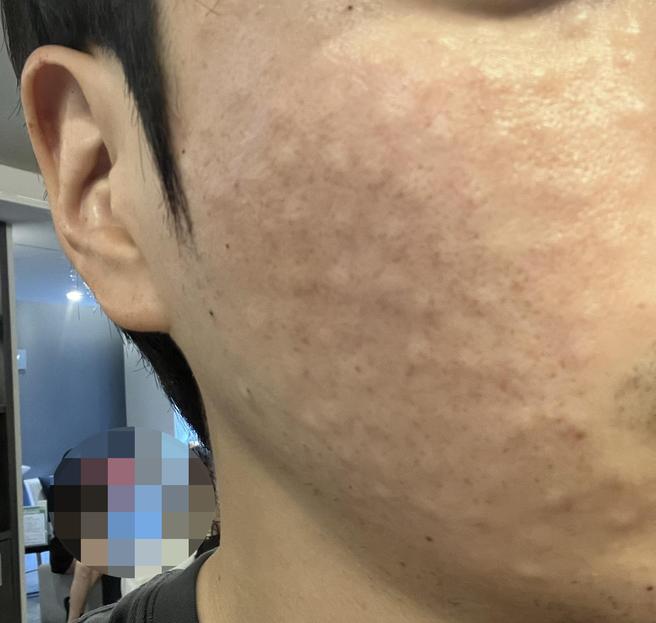 촘촘한 엠보에 친절한 응대까지, 리쥬란 만족스러웠습니다.