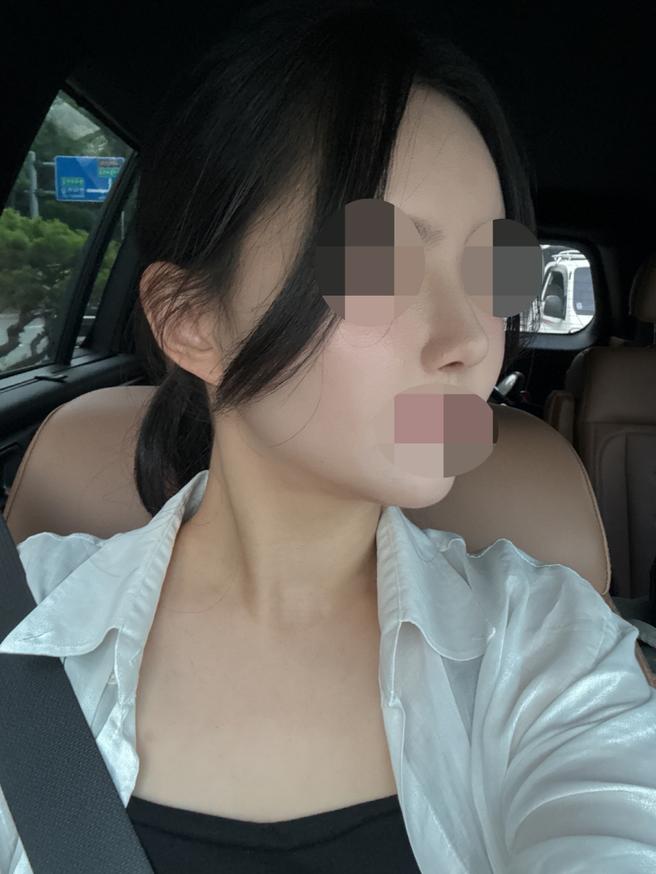안심 코 재수술